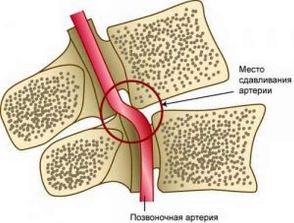 Аритмия при остеохондрозе